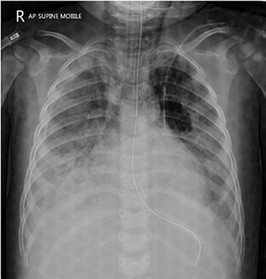Accidental Pyrethroid Ingestion in Toddler: Near-Fatal Atypical Presentation and Successful Recovery